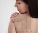 Laser,Tattoo,Removal,On,Woman's,Shoulder.,Medical,Treatment