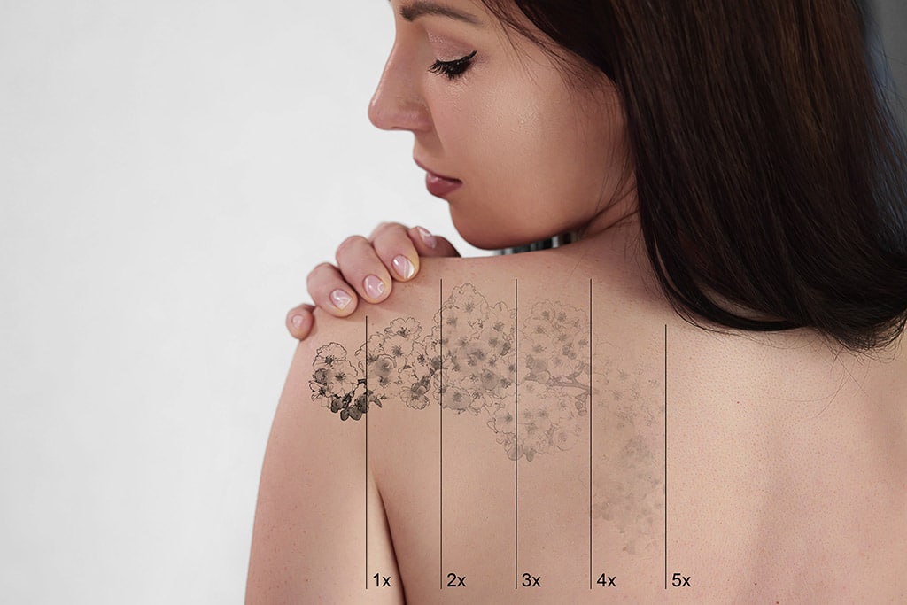 Laser,Tattoo,Removal,On,Woman's,Shoulder.,Medical,Treatment